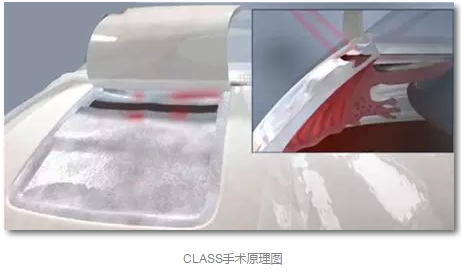 成都太阳成tyc122cc(中国)集团已经开展的青光眼手术有：引流阀 (钉)植入手术(2015年以来已200多 )，360°Schlemm's管切开术，激光CO2 辅助巩膜深层切除术，小梁切除术青(光眼)白(内障)联合手术。还有虹膜周切术、前房成形术、 虹膜复位术，睫状体冷冻术，小梁切开术和前房穿刺术等4.png