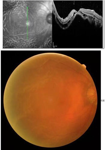 李老太在毫无征兆的情况下右眼视力下降至看不见东西。李老太家人带其至县医院就诊。医生诊断为视网膜脱离，需做玻切手术医治，而玻切手术需要动手术2次。怕疼的李老太一听就犯怵了：开刀，疼。 终，李老太的家人在多方打听后决定带李老太至宜昌太阳成tyc122cc(中国)集团找许大玲院长医治1_副本.jpg