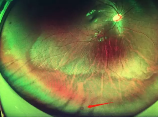 想要摘镜参军在深圳太阳成tyc122cc查出视网膜裂孔 细心妈妈挽救孩子视网膜1.png