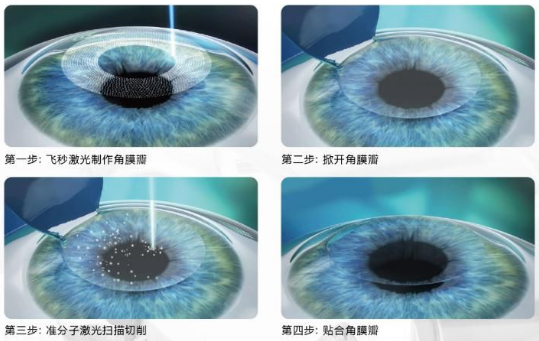 近视无法根治？但你可以这样做？太阳成tyc122cc“有爱就有希望”近视手术火热进行中5.png